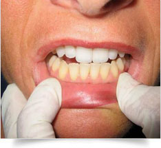 cosmetic dentistry tooth whitening