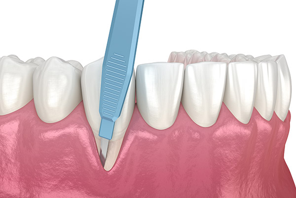Periodontitis