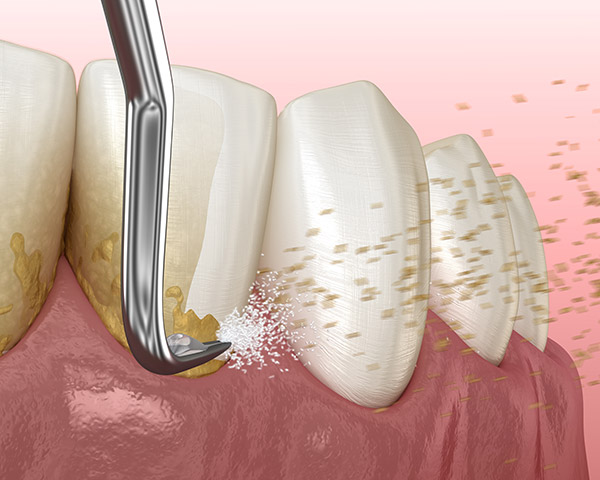 Periodontics dentistry